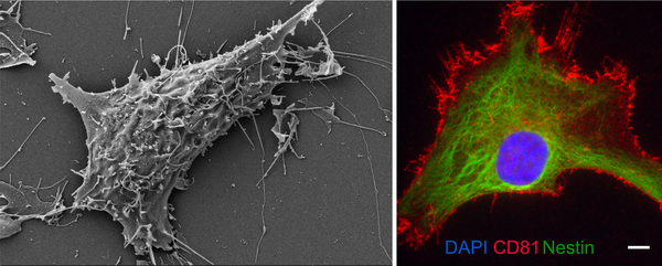 Electromicroscopic images of ependymoma tumor cells with staining