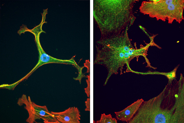 Auch im Labor kultivierte Zellen einer Sarkomkrebszelllinie wachsen im Nährmedium unterschiedlich aus. So können Zellbestandteile (hier: Zellkern blau, grün: Stoffwechselenzym Glutaminsynthetase, rot: Actin) angefärbt und damit sichtbar gemacht werden, um das Verhalten der Krebszellen zu beobachten und ihre Reaktion auf Wirkstoffe zu testen. Bildquelle: Charles S. Umbaugh, Fröhling Lab/NCT Heidelberg