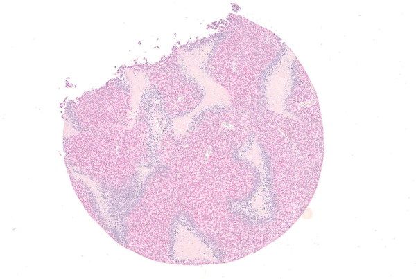 Tissue section Erwing sarcoma with colored biomarkers