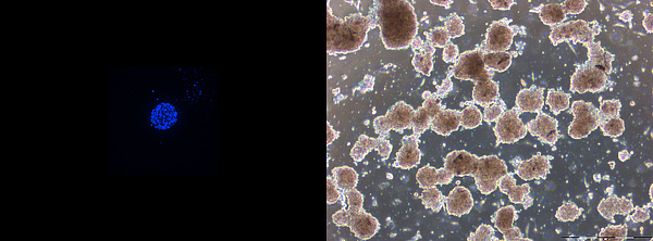 Höchstfärbung einer primären 3D-Tumorkultur (links) , Primäre Kultur 6 Tage nach der Aufarbeitung (rechts).