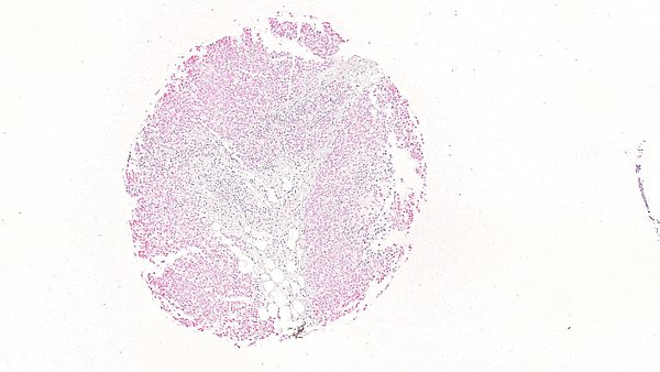 Immunhistochemische Detektion von PRC1 in Ewing-Sarkomgewebe. Bild: T. Grünewald / KiTZ