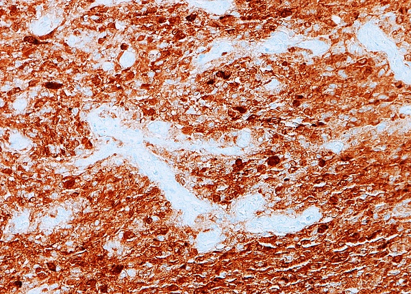 Tumorzellen aus einem kindlichen Hirntumor (Gliom).