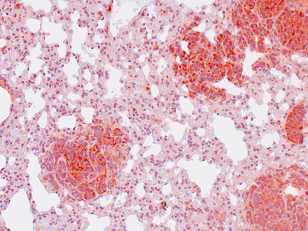 Ewing sarcoma with a strong nuclear marker expression. Image Source: Grünewald/LMU.