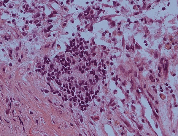 Ansammlung von aggressiven Neuroblastoma Zellen
