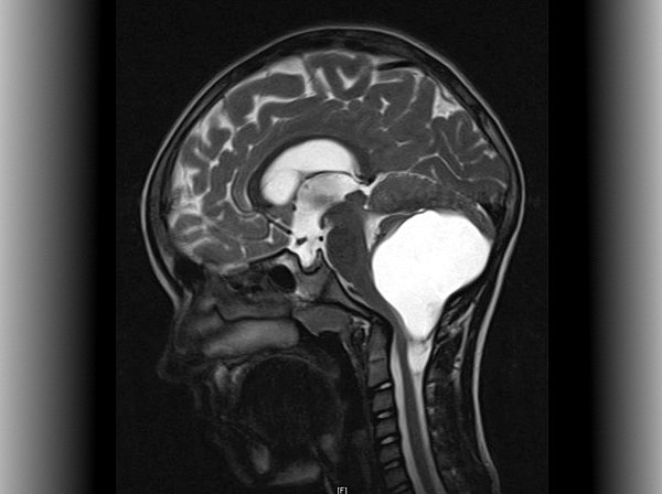 Pediatric low-grade glioma