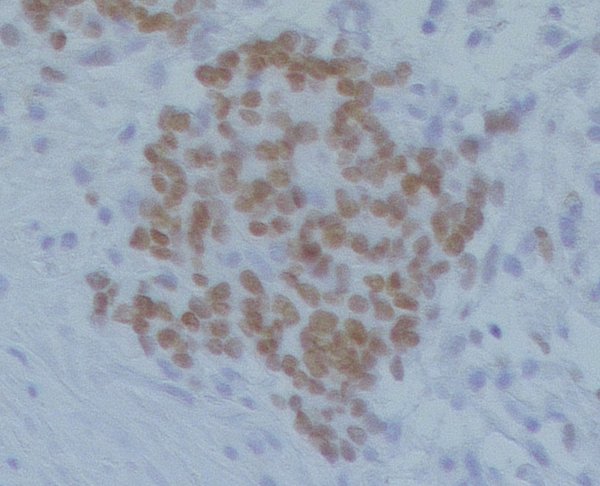 Stained neuroblastoma cells from a liver metastasis.