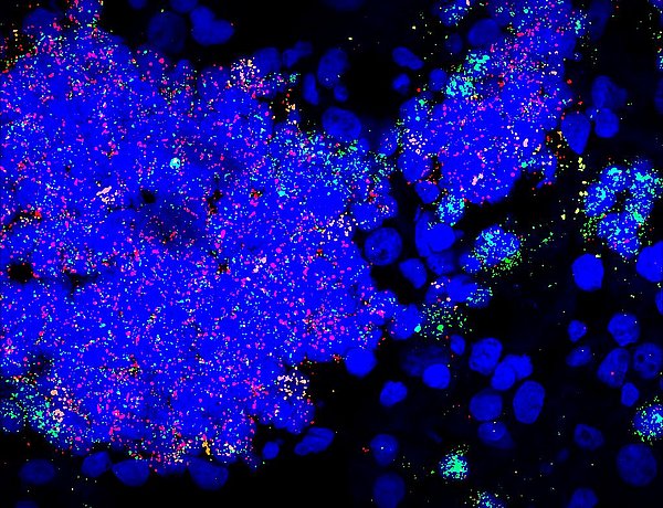 Red, green and yellow indicate nests of neuroblastoma progenitor cells in the adrenal gland. Source: S. Jansky/KiTZ.