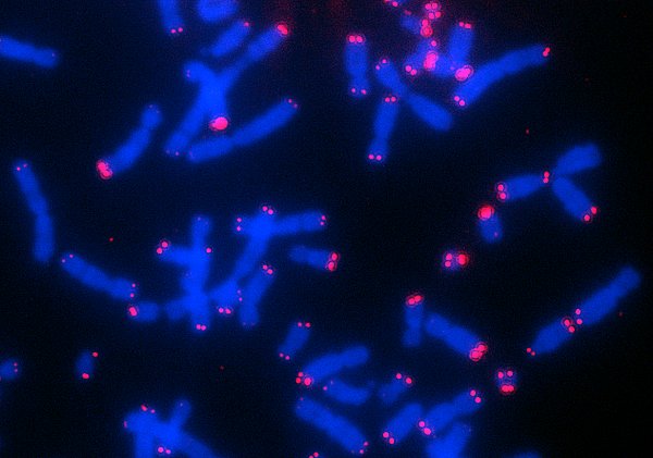 Human chromosomes of neuroblastoma cells. Chromosome ends (telomeres) are shown in red, which are particularly long here.