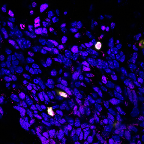 Das Bild zeigt die Produktion des Proteins BCOR (pink) in den Hirnzellen von Mäusen, bei denen das Gen Ptch1 mutiert ist. Besonders viel BCOR wird in Zellen produziert, die sich aktiv teilen (gelb). Bild: Kutscher/KiTZ